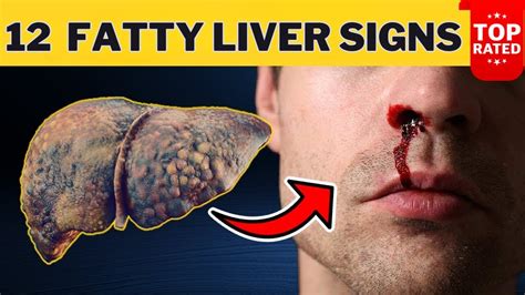 12 Early Signs Of Liver Cirrhosis Liver Is Dying Youtube