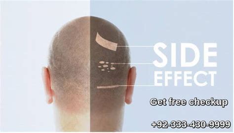 Laser hair transplant side effects Pakistan | Fixing bad hair restoration