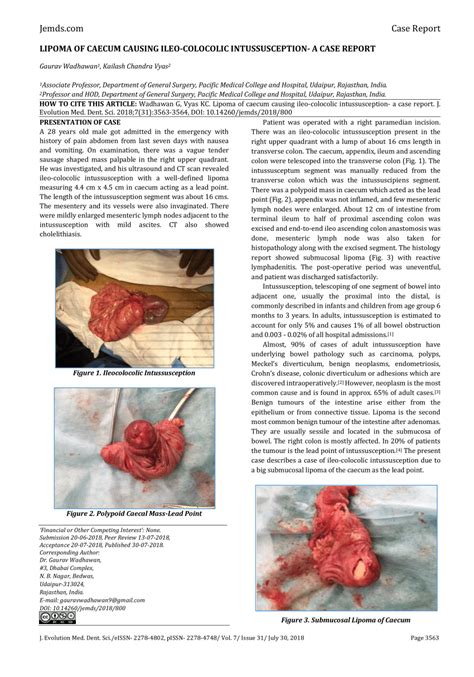 Pdf Lipoma Of Caecum Causing Ileo Colocolic Intussusception A Case