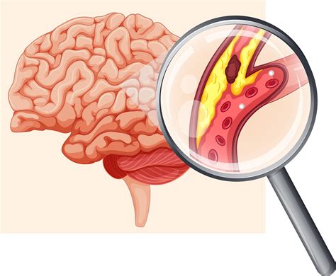 Human Brain with Atherosclerosis 414053 Vector Art at Vecteezy