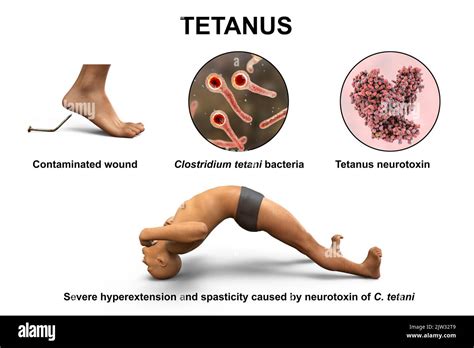 Mecanismo de la enfermedad del tétanos ilustración Una herida en la