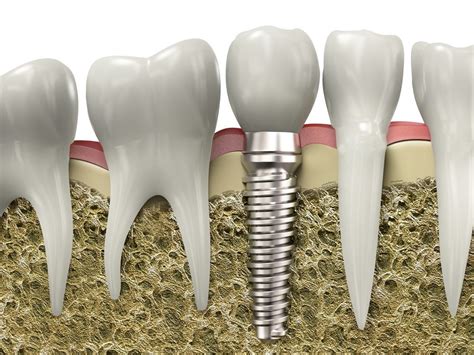 How Do Implants Work For Teeth At Marie Brown Blog