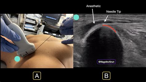 Clavipectoral Block — Highland EM Ultrasound Fueled pain management