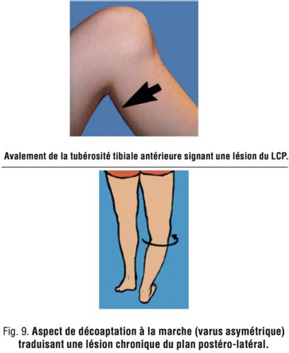 Item 361 Lésions péri articulaires et ligamentaires du genou lésions