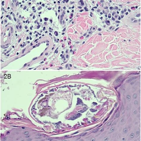 A Sections From The Punch Biopsy Of Skin Show Acanthosis Spongiosis