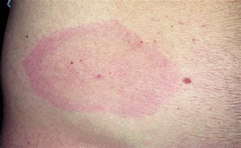 The Characteristic Bullseye Rash For Lyme Disease Innatoss