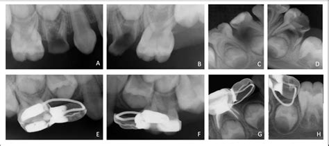 Pre And Post Operative Intraoral Periapical Radiographs A D