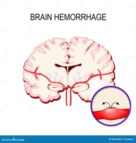 Cerebral Hemorrhage Cartoon Vector 44474853