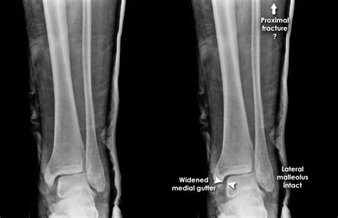 trauma  ray  limb gallery  ankle maisonneuve fracture