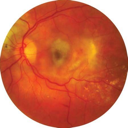 macular degeneration | Description, Forms, & Symptoms | Britannica.com