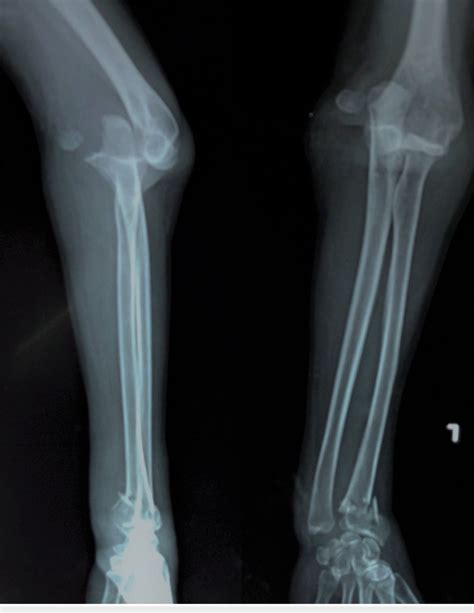 Anterior Elbow Dislocation Along With The Lateral Epicondyle Fracture