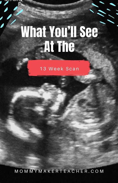 13 Weeks Pregnant Ultrasound: Nuchal Translucency Scan - Mommy Maker ...