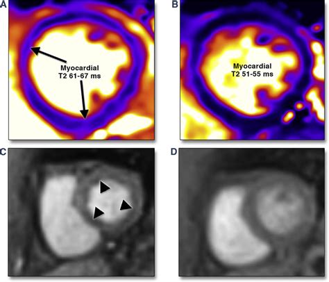 Myocardial Inflammation And Impaired Myocardial Perfusion Reserve By