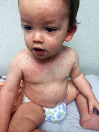 Allergic Reaction Heat Rash On Babys Scalp Identify Baby Eczema Images