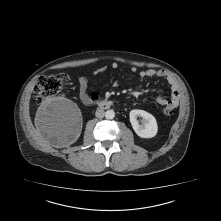 Primary Retroperitoneal Hydatid Cyst Radiology Case Radiopaedia Org