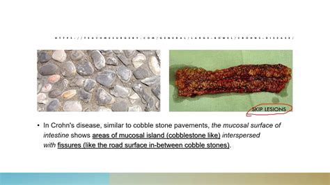 Why Is ‘cobble Stone Appearance Of The Bowel’ Seen In Crohn S Disease Skiplesions Youtube