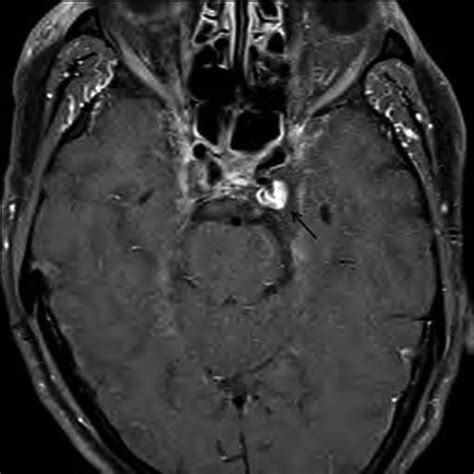 Septic Cavernous Sinus Thrombosis Due To Campylobacter Rectus Infection Bmj Case Reports