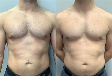 Gynecomastia Before And After Photos Arroyo Plastic Surgery