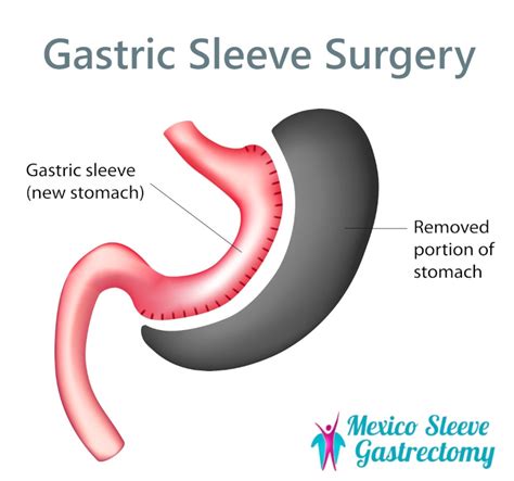 Gastric Sleeve Success Rate and Results - Mexico Sleeve Gastrectomy