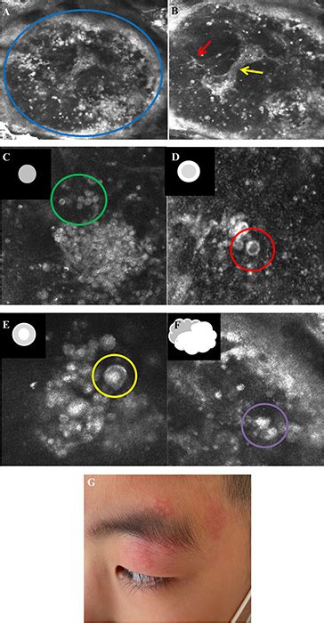 Jle European Journal Of Dermatology Reflectance Confocal Microscopy