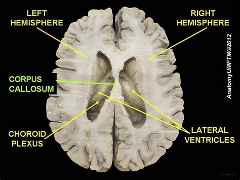 Left And Right Cerebral Hemispheres Corpus Callosum