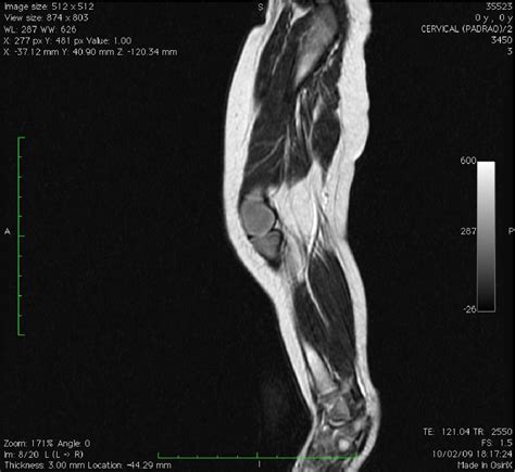 Figure 1 From Popliteal Pterygium Syndrome Semantic Scholar