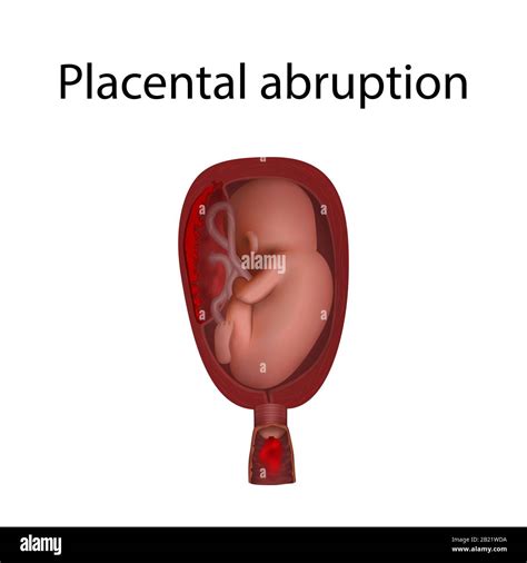 Desprendimiento Placental Abruption Fotografías E Imágenes De Alta