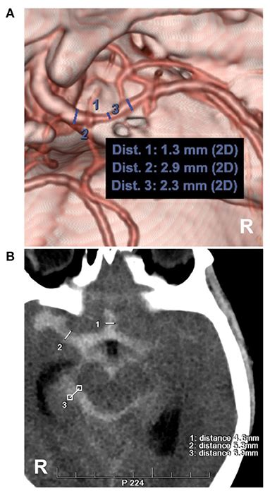 Frontiers Current Status Of Perimesencephalic Non Aneurysmal