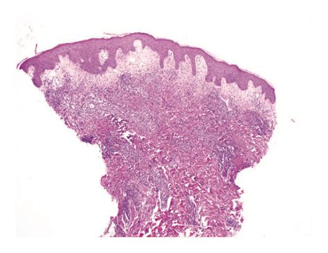 Biopsy findings. (a) Histological section showing fairly prominent ...