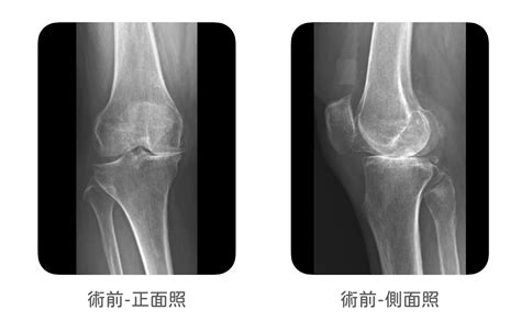 半膝關節置換手術：半膝？全膝？膝關節磨損不用全換更微創？｜蔡尚聞醫師