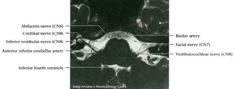 MRI Protocols: 7TH NERVE MRI Protocol(Facial Nerve)