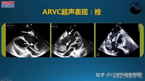 5步法读懂超声心动图，90的医生都不知道！ 知乎