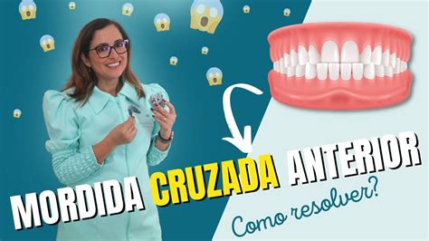 Mordida Cruzada Anterior Como resolver Adornare Odontologia Estética