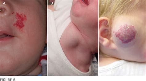 Figure 1 From Diagnosis And Management Of Infantile Hemangioma