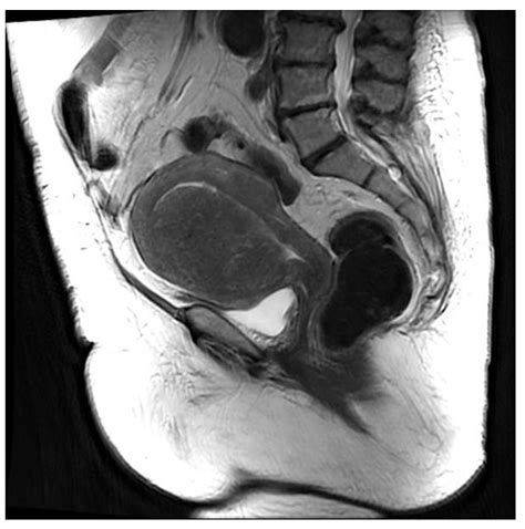 Mri And Adenomyosis What Can Radiologists Evaluate