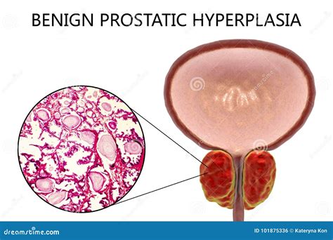 Benign Prostatic Hypertrophy Histology