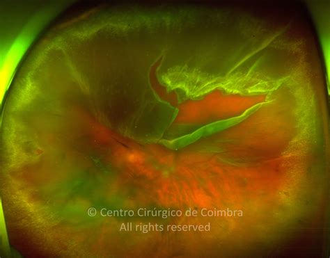 Rhegmatogenous Retinal Detachment Atlas Rl Eye