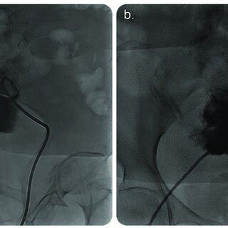 A Fluoroscopic Image Of The Pelvis In An Oblique View Showing A