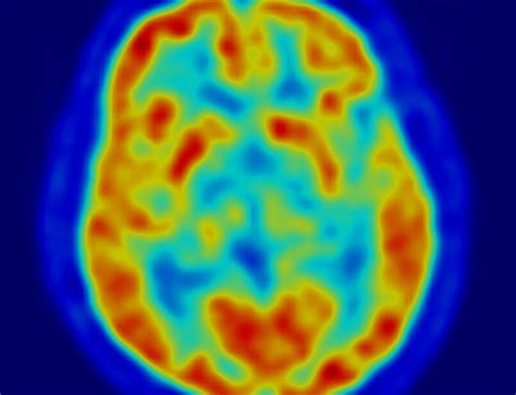 What Your Brain Actually Looks Like on Different Drugs