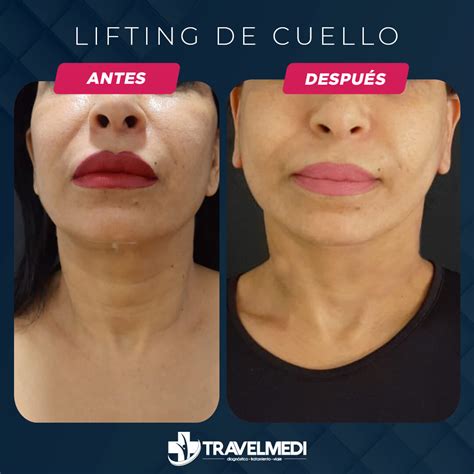 Lifting De Cuello En Turqu A Precios Antes Y Despu S