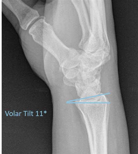 Traumatic Wrist Injury Radiology U Of U School Of Medicine