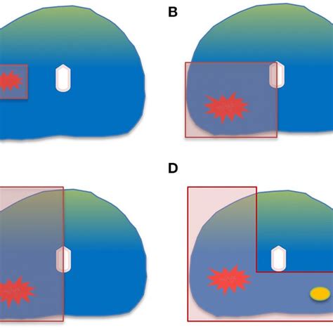 Common Ablation Templates A Focal Ablation B Quadrant Ablation