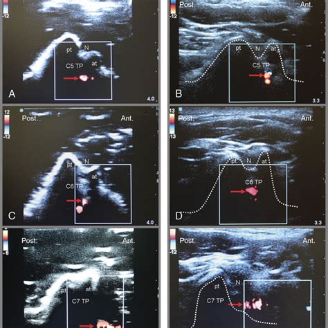 Short Axis Transverse Sonogram With Color Doppler Demonstrates The Download Scientific Diagram