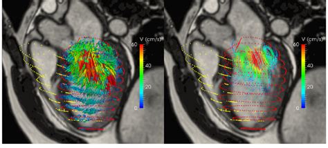 Three Dimensional Visualization Of Intra Cardiac Flow Used To Show