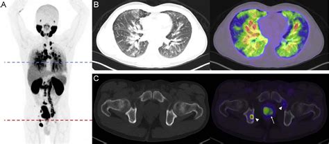 Lymphangitic Carcinomatosis From Prostate Cancer Identified With Gallium 68 Prostate Specific