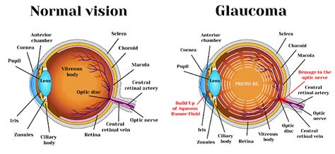 Glaucoma And Diabetes - DiabetesWalls