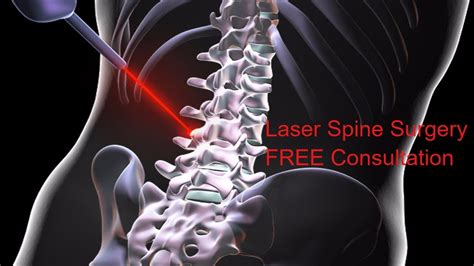 Laser Spine Surgery Lexington Ky Minimally Invasive Spinal Surgery