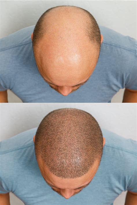 Non Surgical Hair Restoration With Prp Via Health And Medspa