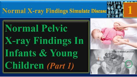 Pelvic X Ray Normal Findings In Infants And Young Children Youtube