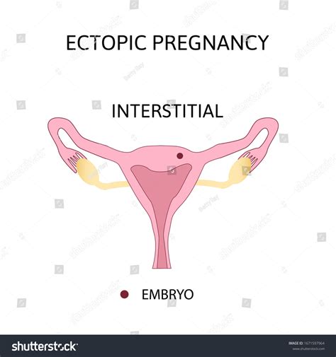 Ectopic Pregnancy Types Extrauterine Pregnancy Interstitial